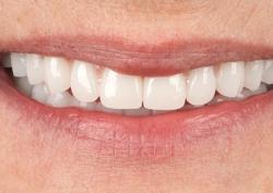 Имплантация нижней челюсти по протоколу All-on-4