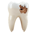 Лечение постоянных зубов