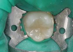 Лечение зуба с восстановлением вкладкой