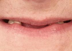 Имплантация нижней челюсти по протоколу All-on-4