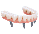 Несъёмный протез на имплантах