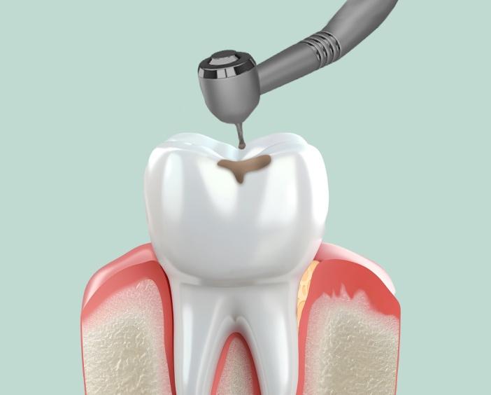 Лечение кариеса