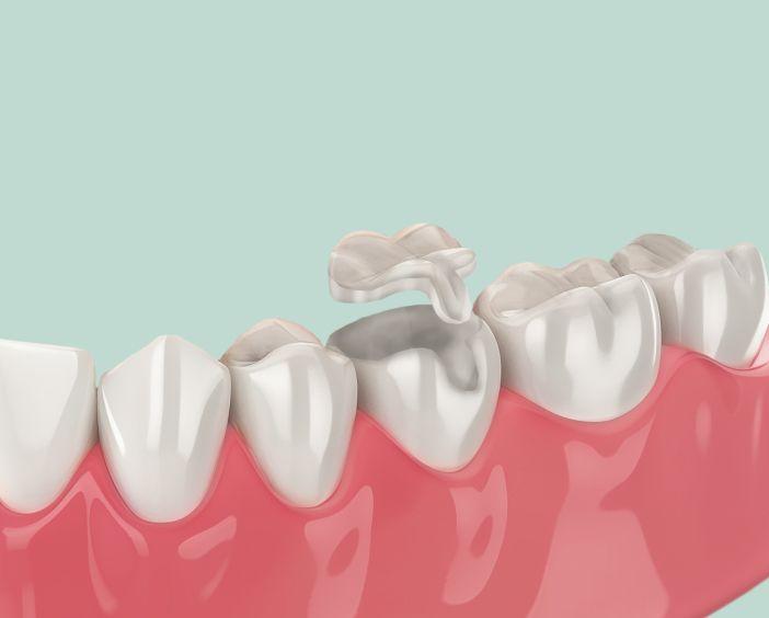 Реставрация зубов