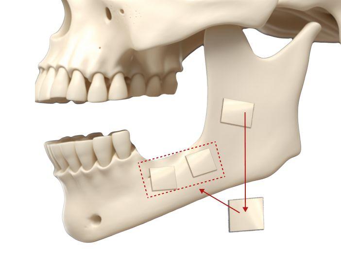 Аутокость (собственная кость пациента)