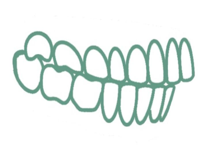 Дистальный прикус