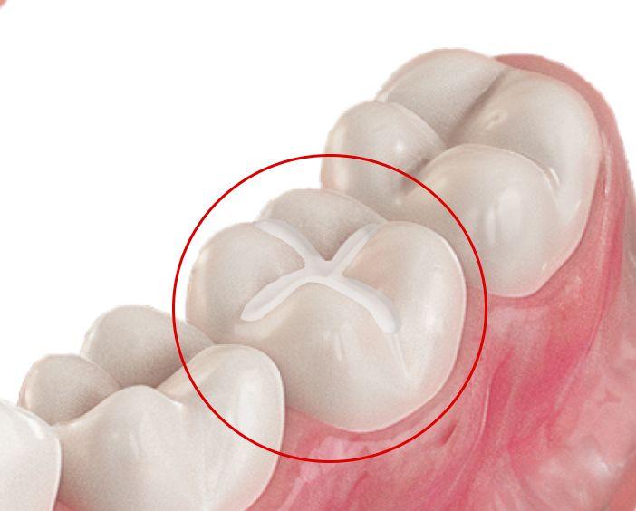 Герметизация фиссур