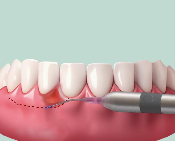 Хирургическое лечение воспалительных процессов