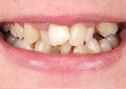 Исправление прикуса металлическими самолигирующими брекетами H4