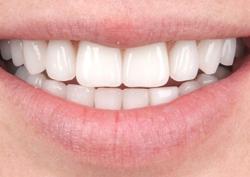 Исправление прикуса металлическими самолигирующими брекетами H4