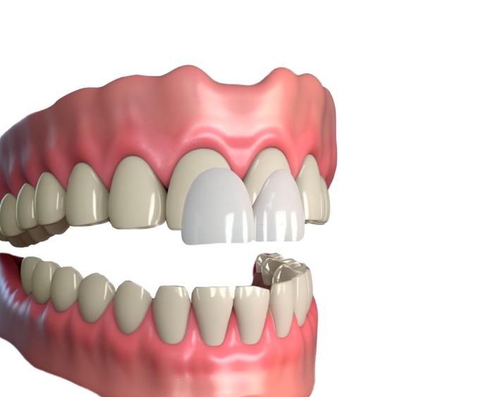Изменение цвета зубов