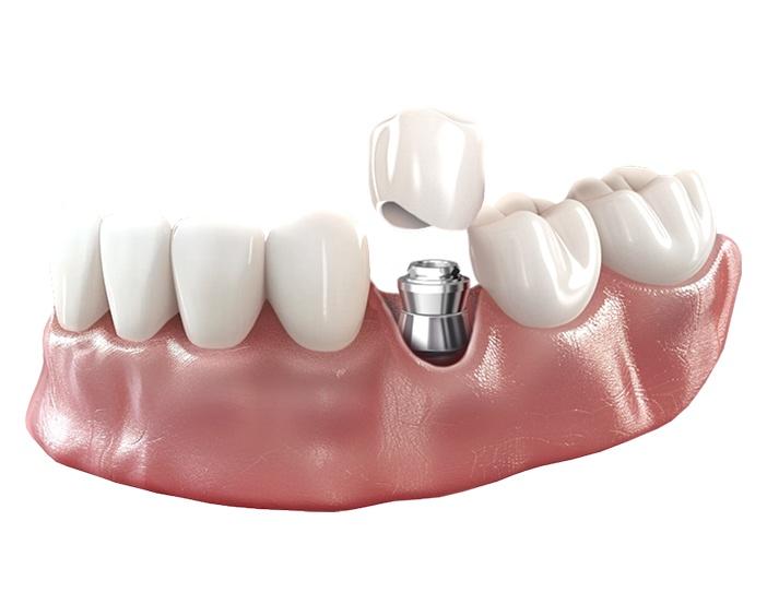 Керамическая коронка