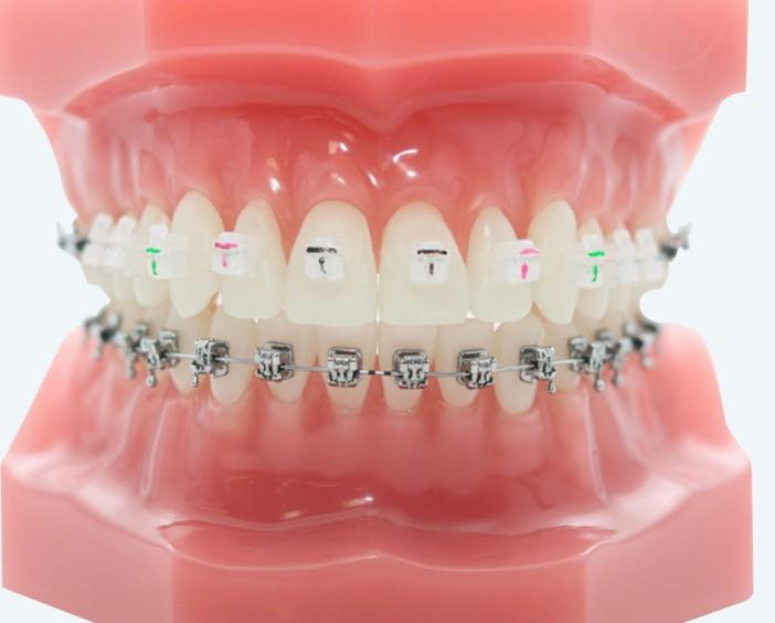 Керамические брекеты Clear21