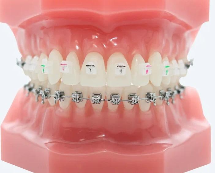 Керамические брекеты