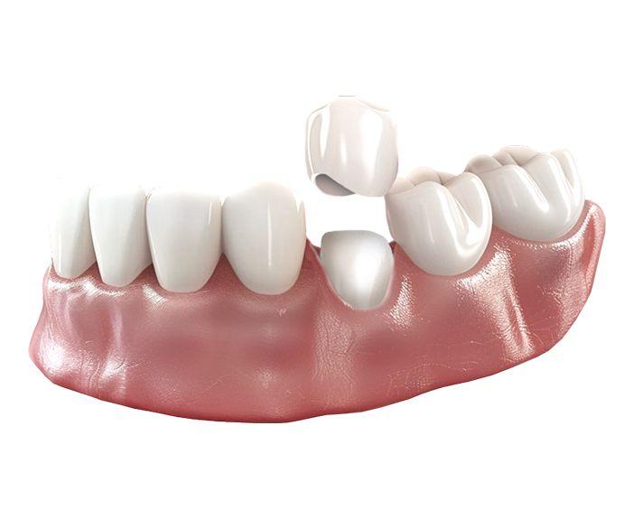 Керамические коронки