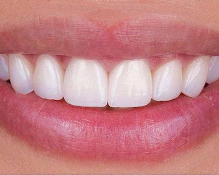 Керамические виниры (E.max)