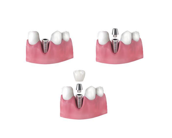 Классическая (двухэтапная) имплантация