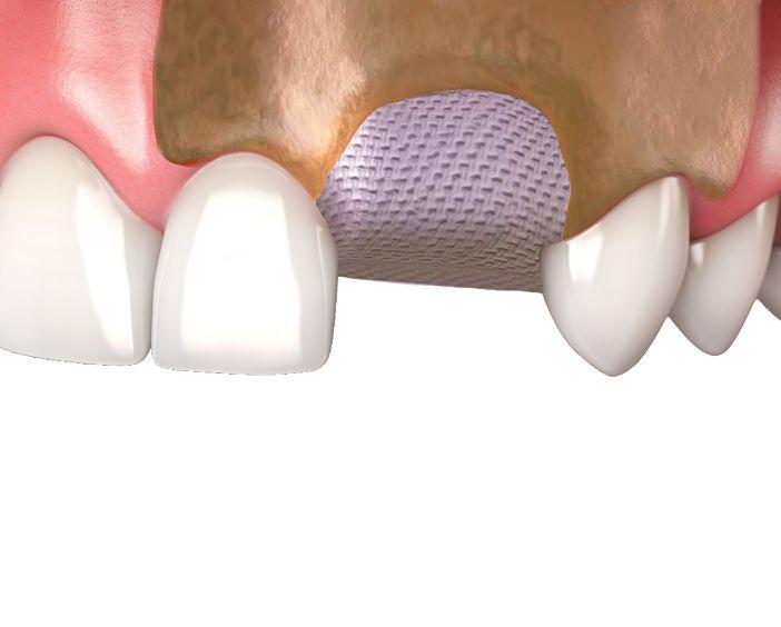 Коллагеновая мембрана