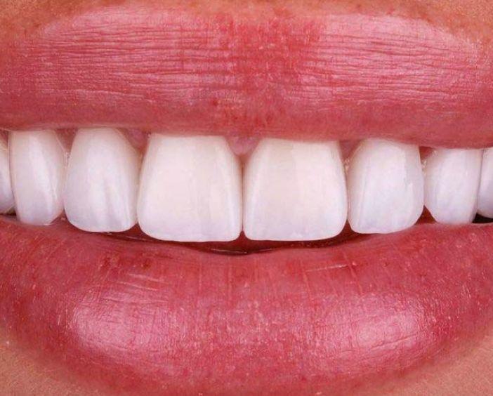 Композитные виниры