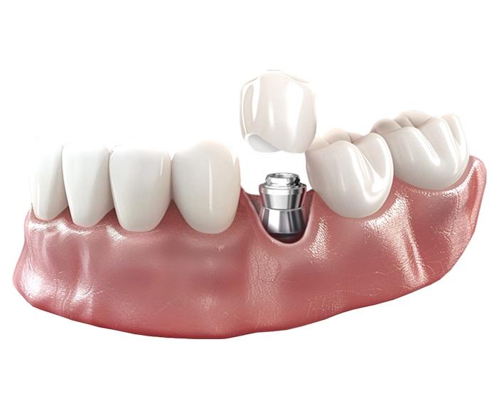 Коронка из диоксида циркония