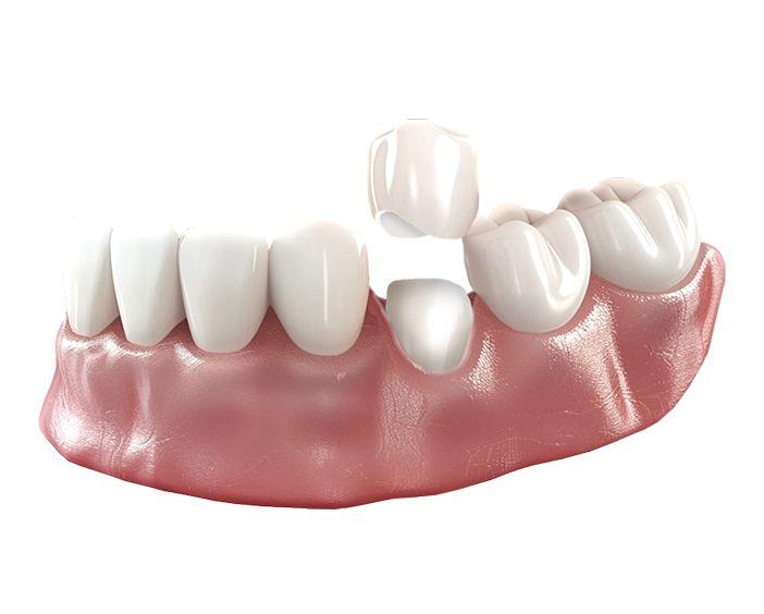 Коронки из диоксида циркония