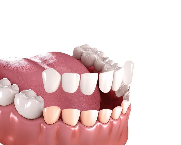 Коррекция формы зубов