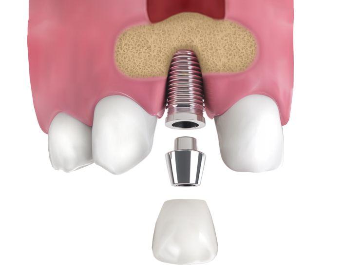 Ксеногенный материал (на основе натурального костного матрикса)