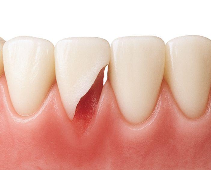 Лечение острых травм зубов