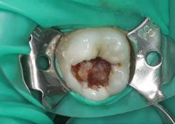 Лечение зуба с восстановлением вкладкой