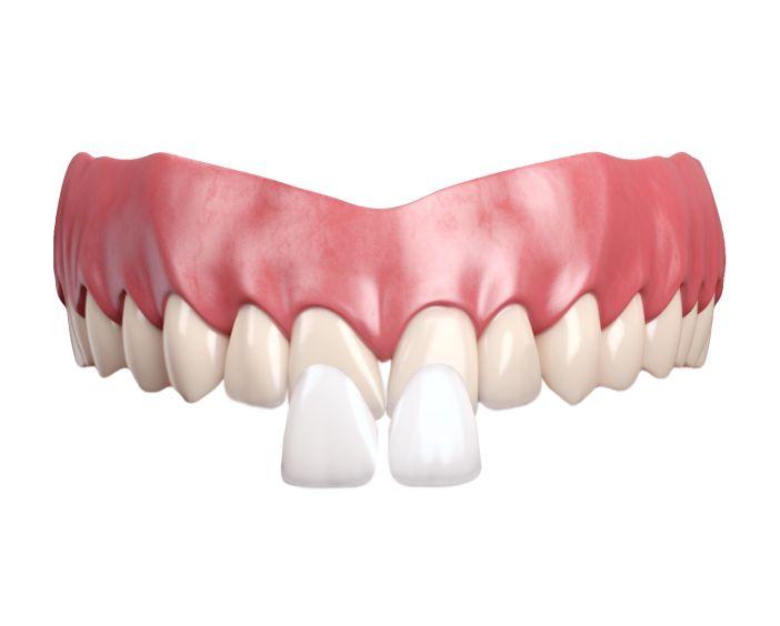 Лёгкая коррекция неровностей