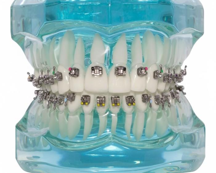 Металлические брекеты 