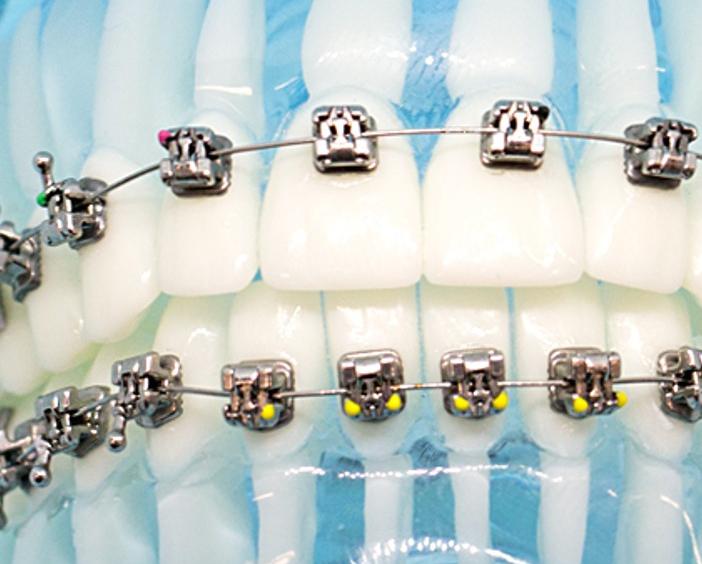 Металлические самолигирующие брекеты