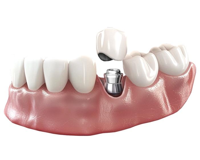 Металлокерамическая коронка