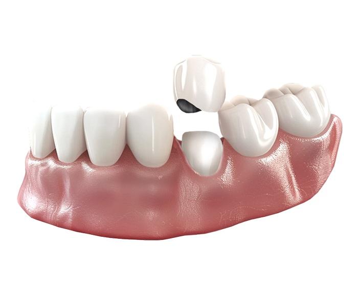 Металлокерамические коронки