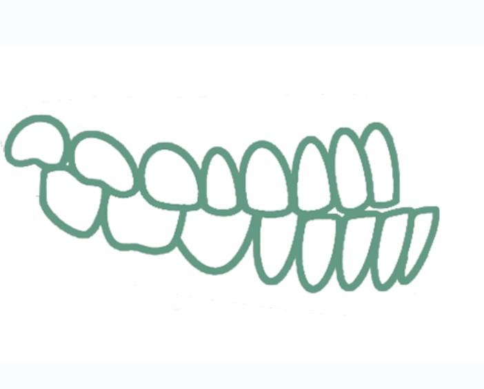 Мезиальный прикус