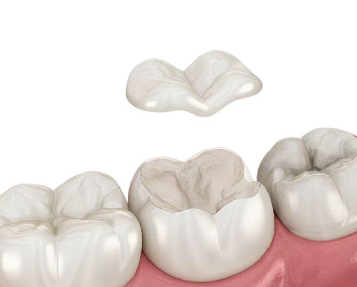 Микропротезы