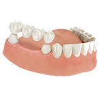 Мост на свои зубы