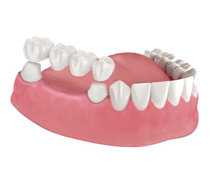 Мостовидный протез