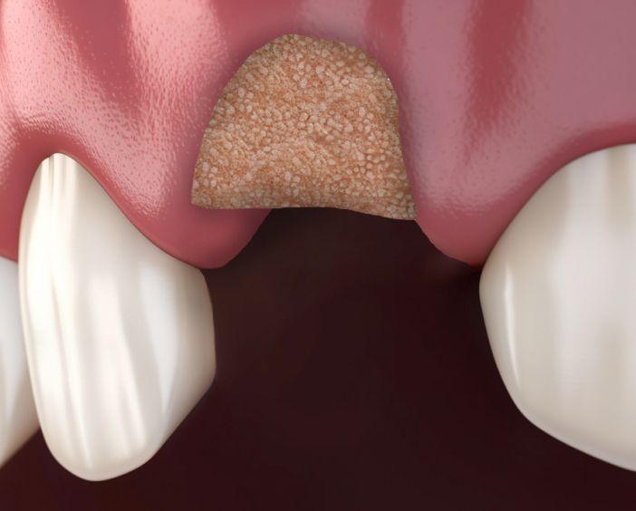 Направленная костная регенерация (НКР)