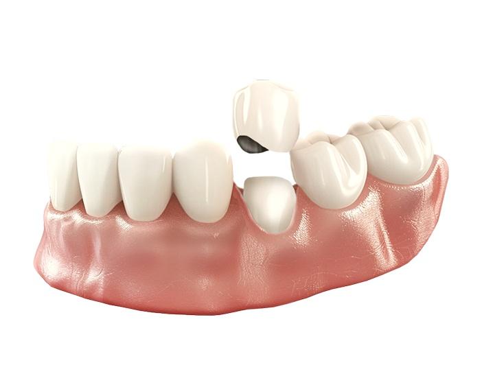 Несъёмное протезирование