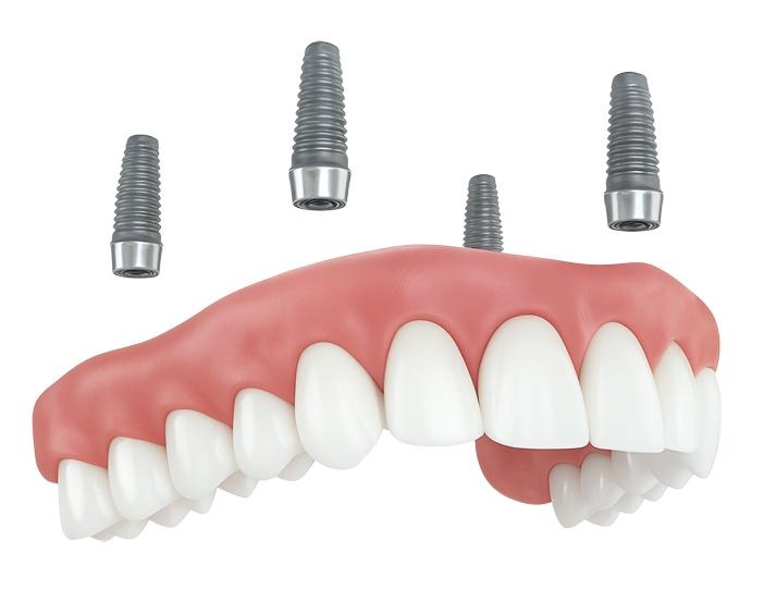 Несъёмные протезы на имплантах