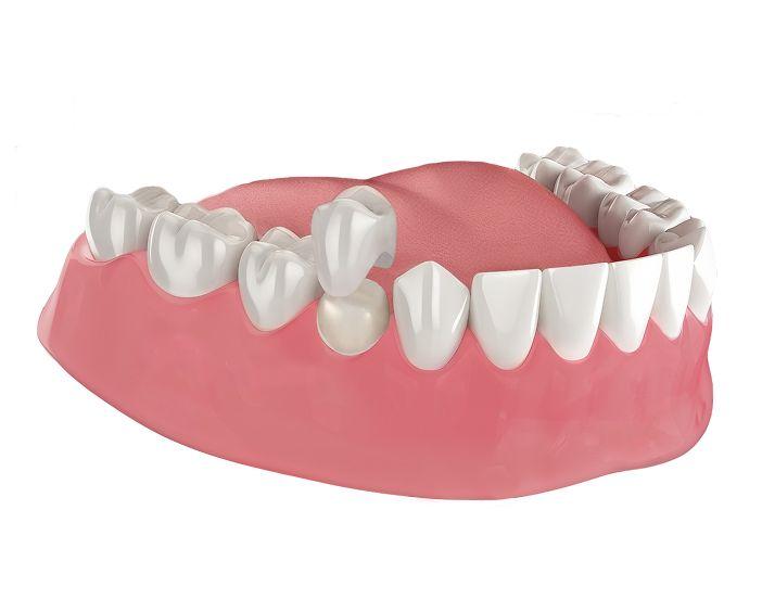  Одиночная коронка