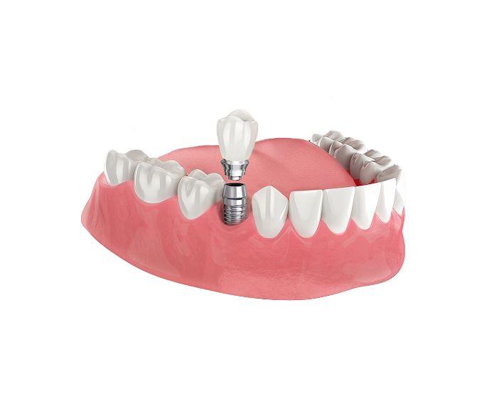 Одноэтапная имплантация