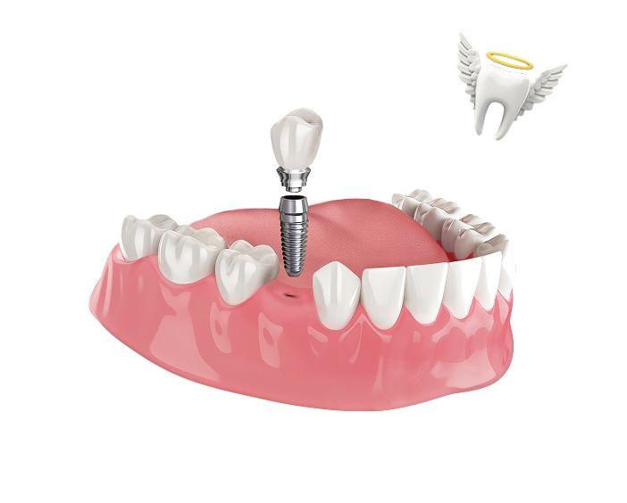 Одномоментная имплантация