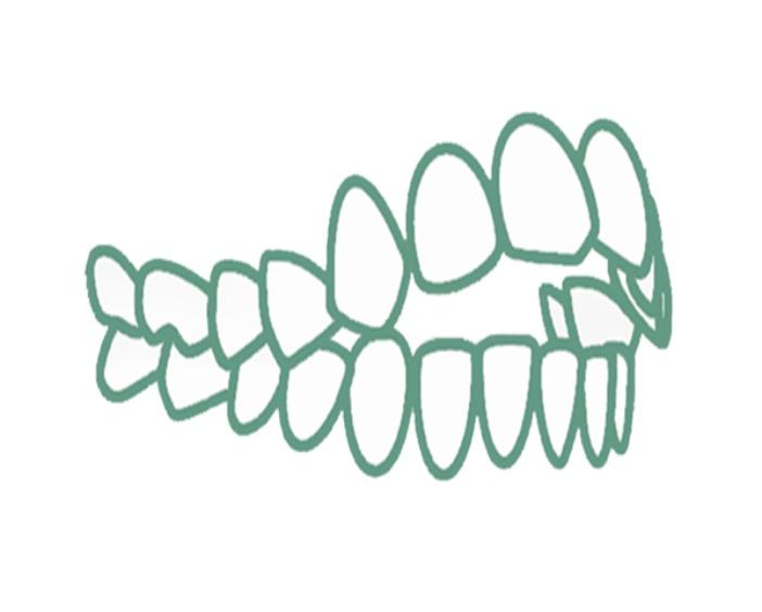 Открытый прикус