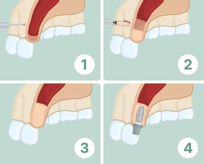 Открытый синус-лифтинг