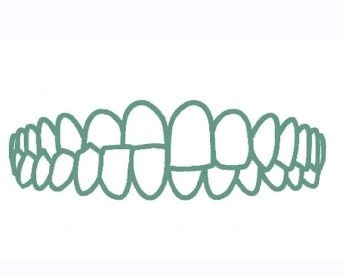 Перекрёстный прикус