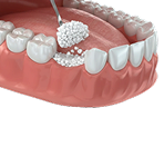 Пластика лунки