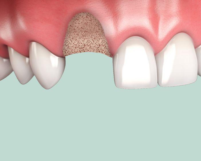 Подготовка к имплантации и протезированию