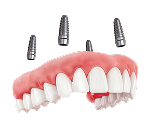 Протез на имплантах