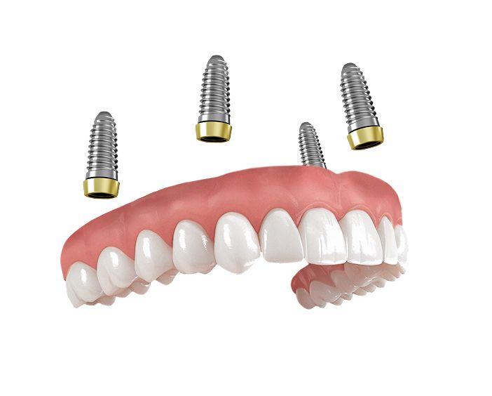 Протезирование на имплантатах